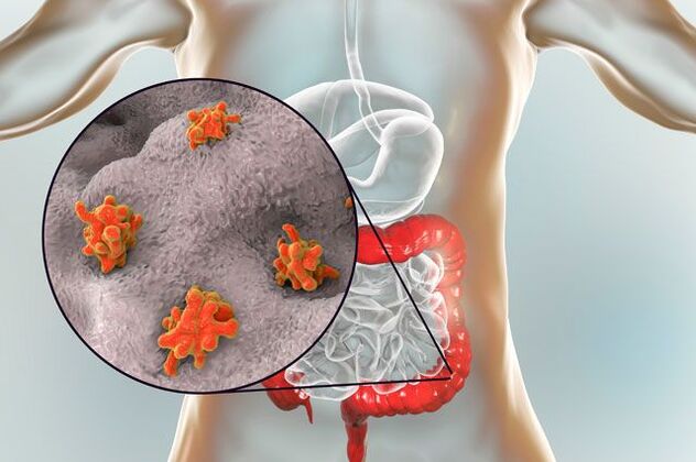 rodzaje pasożytów w organizmie człowieka